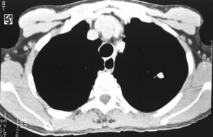 Tomografía computada donde se aprecia un nódulo pulmonar en el pulmón izquierdo – Imagen de BrighamRAD